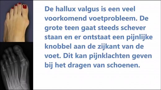 Hallux valgus, operatie volgens een Minimaal Invasieve Methode (M.I.S.)