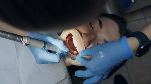 Patient with cheek retractor on. Professional dental cleaning, female patient