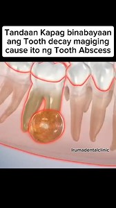 352K views · 806 reactions | This infection leads to a pocket of pus, forming a Tooth abscess, which requires immediate dental care to prevent serious complications. #irumadentalclinic #pov #periapicalabscess #oralhealth #awarenessday #tips #oralsurgery #awareness #oralcare #dentalcare #pus #oralhealth #oralcare #trend | Iruma Dental Clinic | Facebook