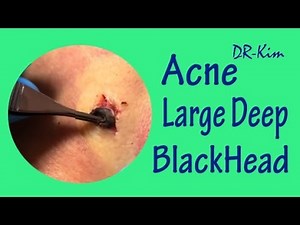 Large Deep Blackheads Satisfying Severe Cyst Acne Treatment Extraction -Blackheads Removal