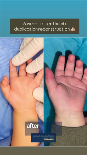 Polydactyly / Thumb Duplication