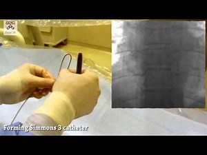 Preview JVIR Video Article: Adrenal Vein Sampling