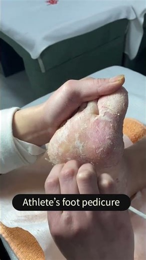 I like scraping athlete's foot the most #athletesfoot #foot #腳氣 #relax #pedicure #satisfying #修腳