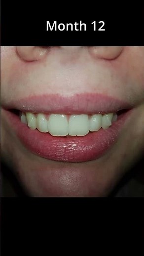 Top teeth - Invisalign Timelapse #invisalign