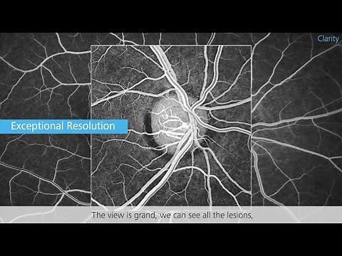 First Experience with ZEISS CLARUS 700 with Dr. Abhinav & Dr. Ravinder