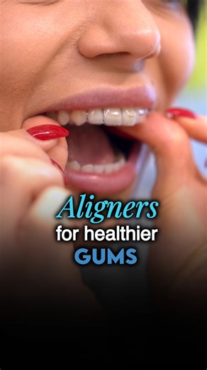 🦷 Crooked teeth increase your risk for gum disease by up to 46%. That's not just a statistic — it's a wake-up call. Here's what most people don't realize: clear aligners aren't just about getting a straighter smile. They're about protecting your long-term health. When teeth overlap or crowd together, it becomes incredibly difficult to clean between them properly. Plaque builds up in those tight spaces, and over time, that leads to inflammation, deeper cleanings, and gum issues that can affect y