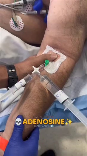 medicos_world on Instagram: "🫀Adenosine in action: a behind-the-scenes look at the drug administration #cardiology #adenosine #medicine #doctor #medico #svt #arrhythmia #nursing #explorepage #foryou #reels"