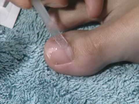 如何正確使用樂指利Loceryl(灰指甲用藥)