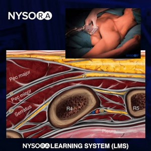 🔹Which structures must be recognized in the US image to perform a PEC II block? 1. The pectoralis major and minor muscles 2. The serratus anterior muscle 3. The 4th and 5th ribs NYSORA's Cognitive Priming Learning™ facilitates understanding, knowledge acquisition, and retention. Test drive NYSORA's learning tools on the Regional Anesthesia Learning System (LMS) and all new Nerve Blocks mobile app (iOS, Android). 🖥 NYSORA Regional Anesthesia LMS: http://nysoralms.com/ 📱 NYSORA Nerve Blocks: An