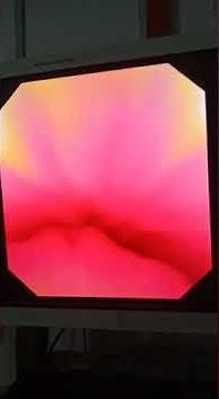 Male cystoscopy view. normal