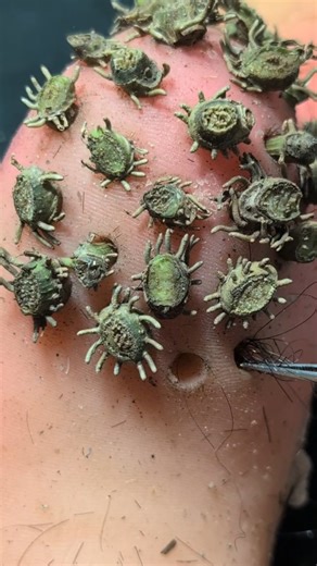 42K views · 79 reactions | Extremely plucking Facial Cleaning And Remove, How is a Lovely video 2025 11 30 12 41 41 | 1M Followers | Facebook