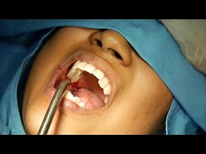 Infected Wisdom Teeth Removal | Wisdom Tooth Extraction | Dr. Sunil Richardson
