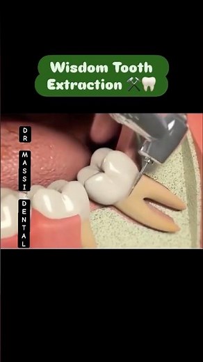 Impacted Wisdom Tooth | Surgical Sectioning ASMR Demo