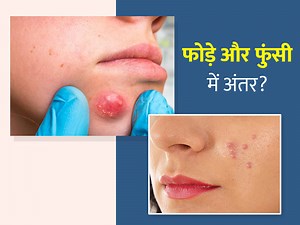 फुंसी (पिंपल्स) और फोड़े में अंतर कैसे पहचानें? जानें दोनों समस्याओं के कारण और बचाव के उपाय