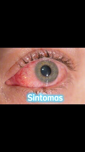 Conjuntivite, causas e tratamento… #conjuntivite #olhos #virus #bacterias #alergia | Edgar Seque