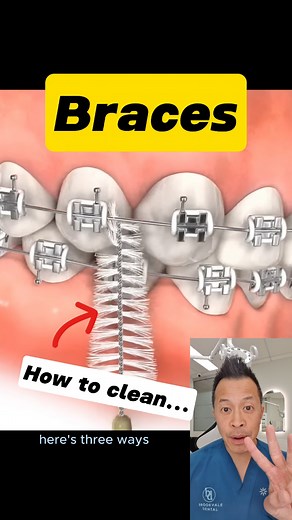 Braces Cleaning Hacks You Wish You Knew Sooner