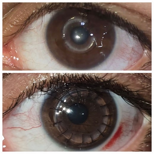 رفع حلقات من قرنية العين بعد انفلاتها مع زرع جزئي للقرنية بنفس العملية Corneal ring removal after extrusion followed by Manual DALK . | د اديب عقراوي لجراحات القرنية والماء الابيض والليزك والحول