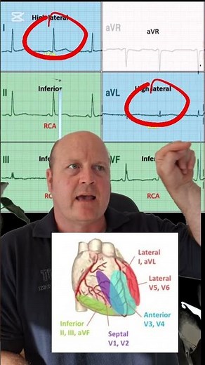 What are the contiguous leads of a 12 lead ECG?
