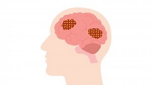 human brain tumor cancer disease medical science animation