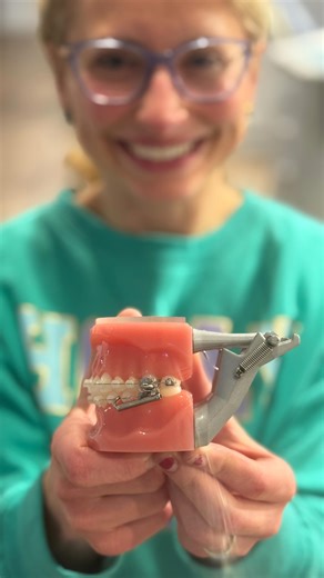 Caroline Albea Orthodontics on Instagram: "Do you have a bite that requires headgear, but you want a different option? Check out how we corrected this overbite with an appliance called Forsus. It stays in the mouth attached to the braces, making compliance much easier. #braces #orthodontics #forsus #orthodontist #albeaorthodontics #headgear"
