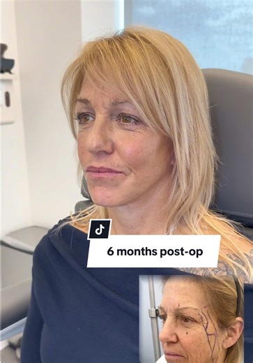 From surgery day to stunning transformation * Watch our beautiful patient's facelift journey with Dr. Madnani-from the morning of her procedure, to her markings, to 6 months post-op. The results? Natural, refreshed, and rejuvenated-just the way it should be #FaceliftJourney #DrMadnani #BeforeAndAfter #NaturalResults #FacialRejuvenation