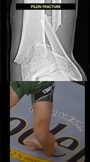 Pilon Fracture on X-ray 😳 Ankle SHATTERED