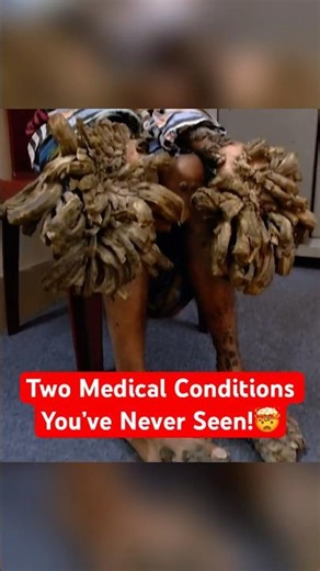 The Rarest Medical Conditions on Earth