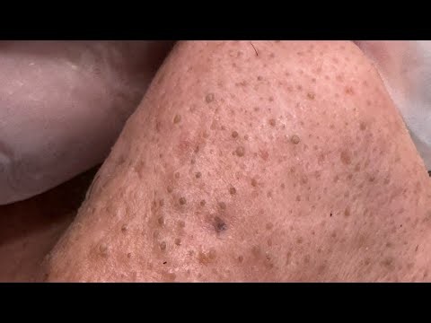 Anua Korean Blackhead Removal Routine (For Sensitive, Acne-Prone Skin)
