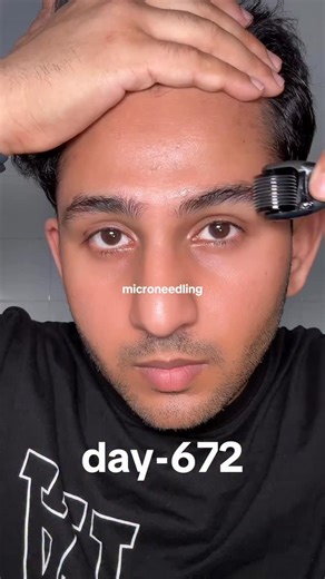 Nirav Patel on Instagram: "day-672 routine completed ✅ Increased my Fin to 3mg/daily for 2 months before switching to Topical Dut 2% Gel from @xyonhealth , I’m feeling better than usual after increasing the dosage. Added Aminexil & Stemoxydine in my routine to reduce hair fall. Minoxidil is still goated for hair growth - anyone above 19 can use it in their routine. I’ve used retinol serum & cream for my face & scalp for 78+ days now and after 90 days on it I’ll switch to tretinoin which is Next