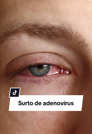 Alerta de Saúde: Casos de Adenovírus em Alta