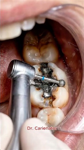 Satisfying Step by Step: Amalgam to Resin 🦷✨
