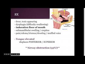 Ludwig's angina: "EM in 5"