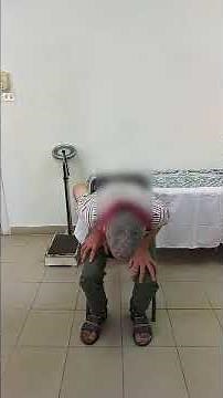 Neurological signs: Chorea