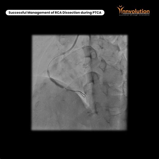 Successful Management of RCA Dissection during PTCA