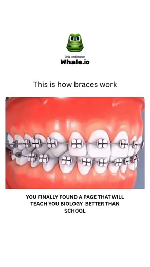 BIOLOGY | MEDICAL | HEALTH on Instagram: "Braces work by applying continuous, gentle pressure to teeth, which signals the body to remodel the jawbone and periodontal ligaments around the teeth. This is a gradual process where the pressure from the archwire and brackets loosens the tooth, causing bone to break down on the side the tooth is being pushed towards, and new bone to form on the opposite side to fill the new space. Regular adjustments by an orthodontist, who will change the wires and el