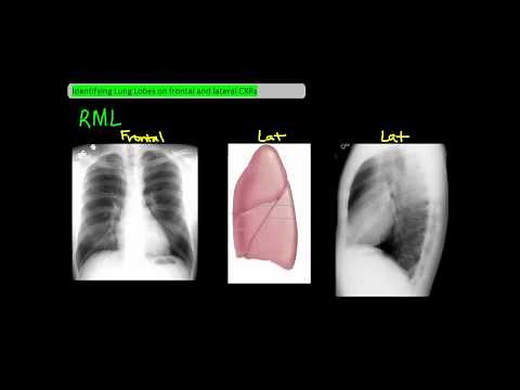 Identifying Lung Lobes on Frontal and Lateral Chest X-Rays [UndergroundMed]