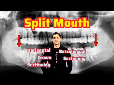 Split Mouth- Horizontal Crown Sectioning vs Buccolingual