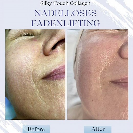 Collagen Fadenlifting vorher nachher