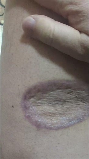 March 14th: Today's rare cancer, malignant melanoma, and the side effect of Opdivo: interstitial ...