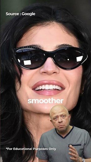 Kylie Jenner Before & After Veeners 🥰