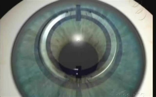 【中英双字】【基质内角膜环植入术】intrastromal corneal ring implantation，ICRI