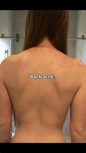 Body Insecurities? 5 Skin Solutions That Restore Confidence! #skinproblems #skincare #skinproblem