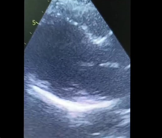 Young male patient was admitted with AWMI. CAG : LAD completely occluded proximally Primary angioplasty performed within first hour of hospital arrival Step by step angioplasty 1.EBU 3.5 F used to hook LCA . 2. FIELDER FC wire parked across the lesion in LAD 3. Predilation done with 2×12 mm, NC ballon 4. Stent - 3.5× 28 mm DES deployed across lesion 5 . Post dilation with 3.5× 28 mm NC, Baloon. Good results achieved Jaipur heart and general hospital, NNL. | Practical Interventional Cardiology