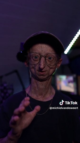 For those of you who were wondering, now you know! #progeria
