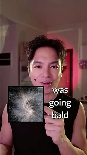 Filipino Pop Star’s Hair Loss Fix — Locklab Review