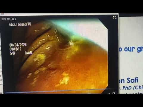 ERCP stent deployment in obstructive jaundice