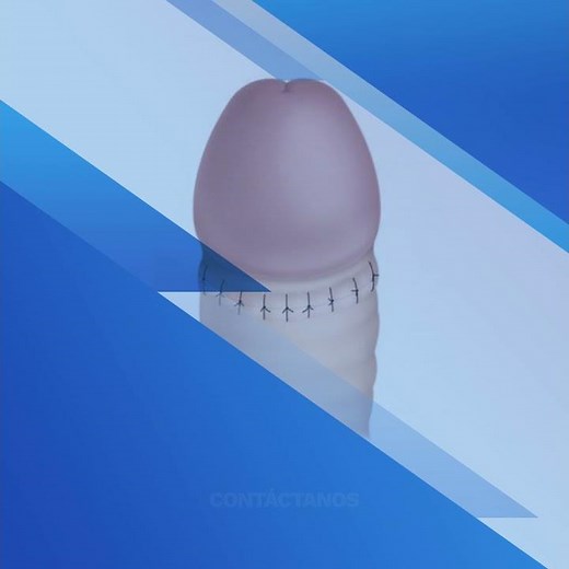 ¿Cómo se realiza una circuncisión? | Androsmedic