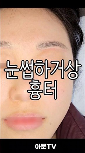Eyebrow Lift Surgery Scar Laser (Plastic Surgery Laser Hospital Plastic Surgery Seoul Scar Laser)...