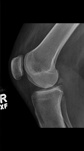 Accessory Bones of the Knee | Os Fabella, Cyamella & Meniscal Ossicle Explained #anatomy #atc #meded