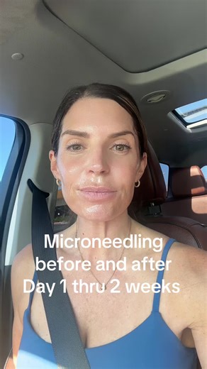 Microneedling Results: Before, After, and Two Weeks Later